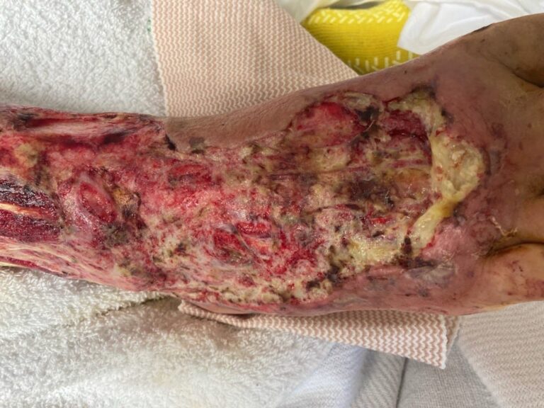 Florida Reports Jumps in Flesh Eating Infections, Five Deaths in 2025